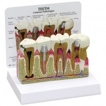 Diseased Teeth and Gums Model