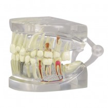 Clear Teeth Model - 2 Sided - Normal, Diseased, Implants