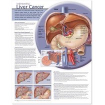Understanding Liver Cancer Chart