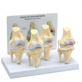 4-Stage Osteoarthritic Knee