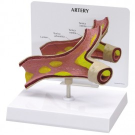 Artery Model (Oversize) with Plaque Build-Up