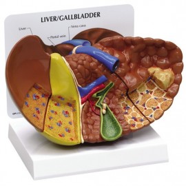 Liver Cancer Model - normal + 3 conditions