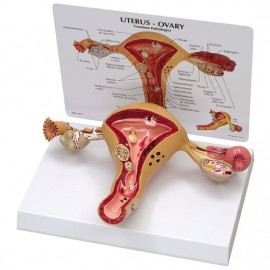 Uterus/Ovary Model with Pathologies