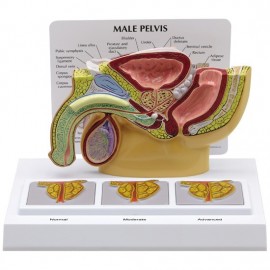 Male Pelvis Model - Cross Section with 3D Enlarged Prostates