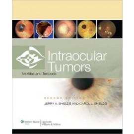 Intraocular Tumors, 2e