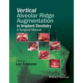 Vertical Alveolar Ridge Augmentation in Implant Dentistry - A Surgical Manual
