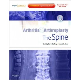 Arthritis and Arthroplasty: The Spine