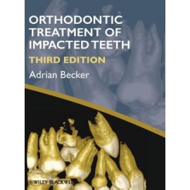 Orthodontic Treatment of Impacted Teeth, 3e