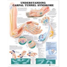 Understanding Carpal Tunnel Syndrome Chart