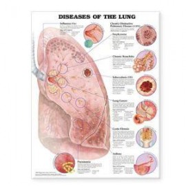 Diseases of the Lung Chart