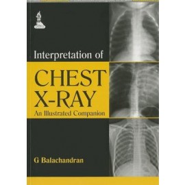 Interpretation of Chest X- Ray