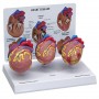 Mini Heart Set Models
